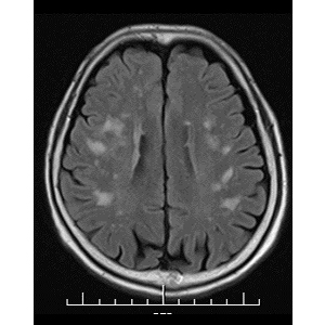 C: ANCA関連血管炎における脳の白質病変