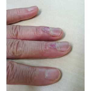 A: 全身性エリテマトーデスにみられる爪周囲潰瘍。